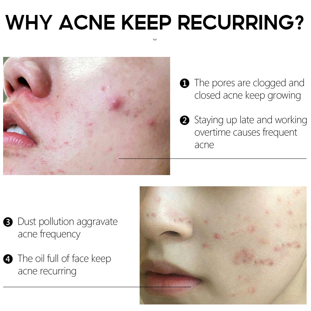 Tea Tree Acne Spots Treatment Serum | Pores Anti-Aging Skin Care Kits